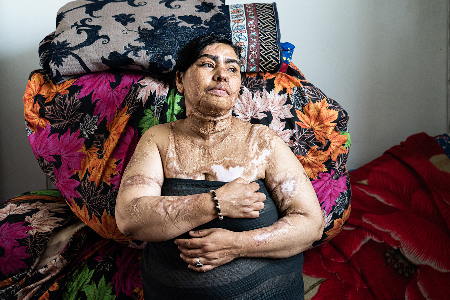 Acid Attack Victim by Hootan Babapourvajari